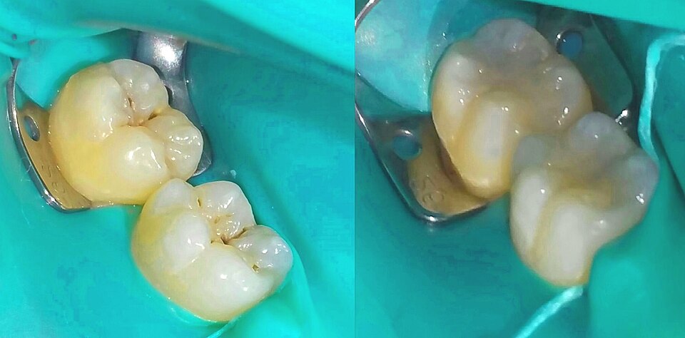 Bonding Ajanı 5ml