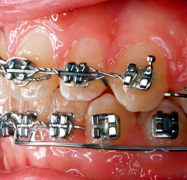 Metal Braket Seti Roth 0.022